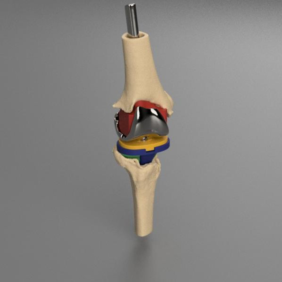 人工全膝关节置换
