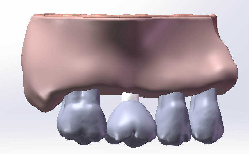 上颌后牙区倾斜0度装配体